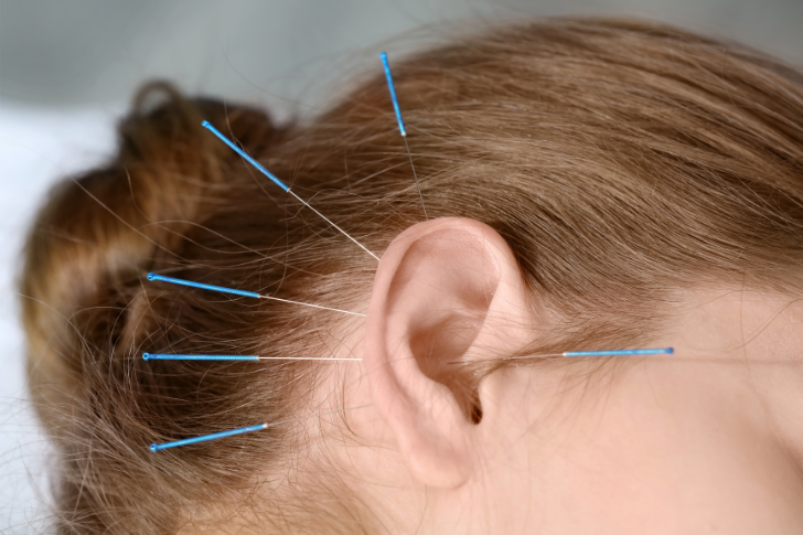 Acupuntura auricular